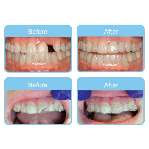 OrVance Retainer Cleaner Tablets (56 Count) & OrVance Pontics (32 Count)