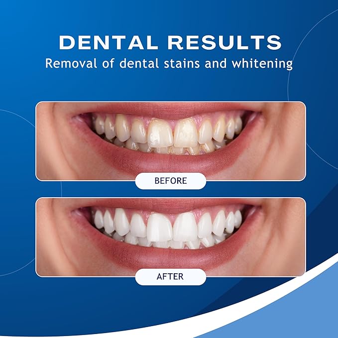 Ultrasonic Electric Teeth Polisher - Rechargeable Dental Calculus & Plaque Remover with 5 Heads, 3 Modes, and LED Light for At-Home Dental Care