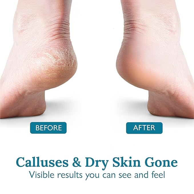 Foot Callus Remover Kit - 40% Urea Cream & Handmade Terra-Cotta Pumice Stone for Feet - Callus Remover for Feet with Shea Butter & Aloe Vera - Cracked Heel Treatment & Moisturizer